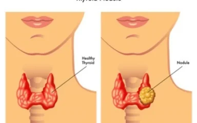 Thyroid nodule image