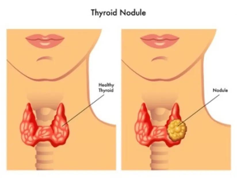 Thyroid nodule image