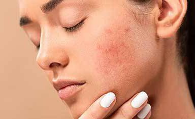 treatment of oily and acne prone skin zomorad
