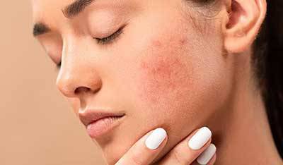 treatment of oily and acne prone skin zomorad