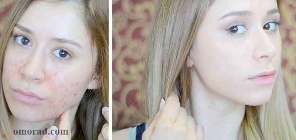 zomorad.com-post-Why does my face break out after applying foundation-چرا صورتم بعد از کرم پودر جوش می‌زند-02