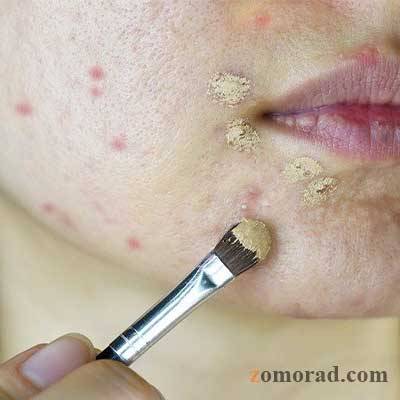 zomorad.com-post-Why does my face break out after applying foundation-چرا صورتم بعد از کرم پودر جوش می‌زند-04