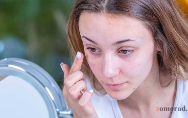 zomorad.com-post-Why does my face break out after applying foundation-چرا صورتم بعد از کرم پودر جوش می‌زند-main